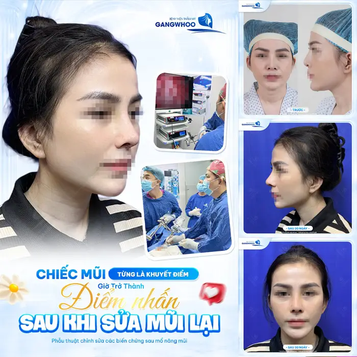 Chiếc mũi từng là khuyết điểm sau khi sửa mũi lại nhan sắc thăng hạng diên mạo thêm cuốn hút và đầy rạng rỡ