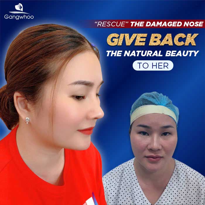 contracted nose after rib cartilage rhinoplasty 1