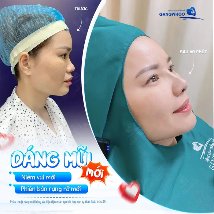 Dáng mũi mới niềm vui mới phiên bản rạng rỡ ngay sau khi vừa hoàn thành ca phẫu thuật 