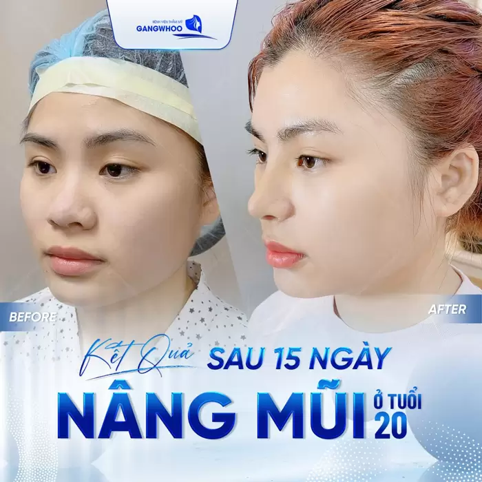 Nâng Mũi Sụn Sườn Có Đau Không