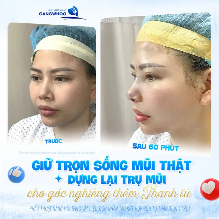 Sau 60 phút phẫu thuật nâng mũi bằng vật liệu độn nhân tạo góc nghiêng cao đẹp thêm thanh thoát và hài hòa