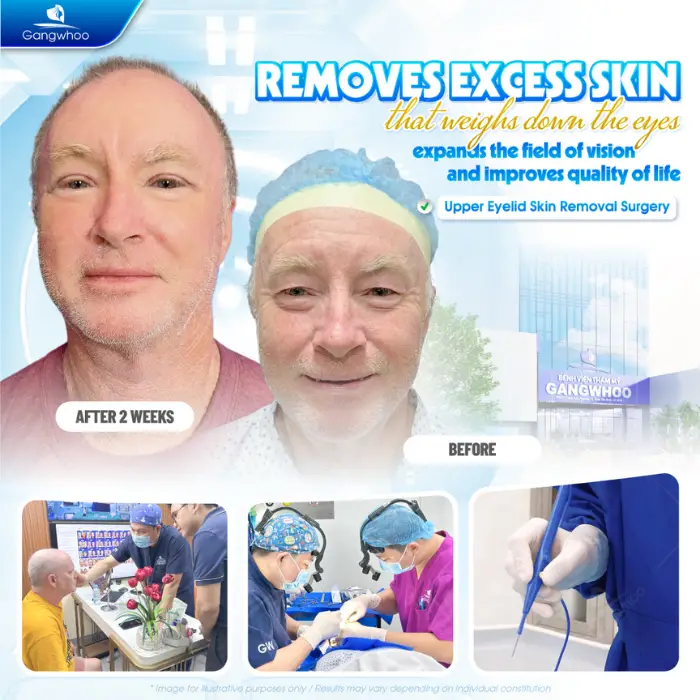 facial excess skin removal 1