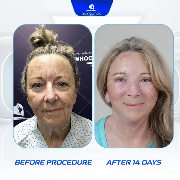 facial excess skin removal 3