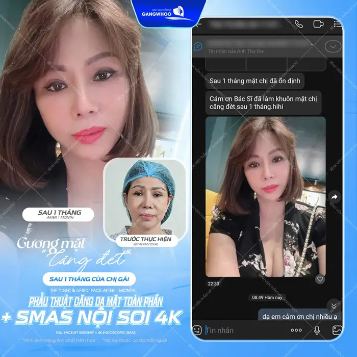 fb sau 1 thang phau thuat cang da mat tai bvtm gangwhoo