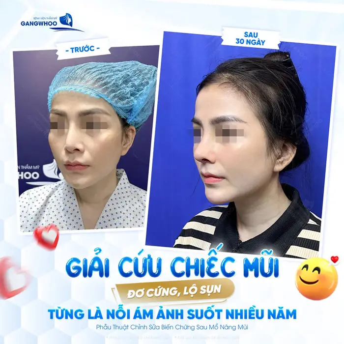 Biến Chứng Nâng Mũi Sụn Sườn Và Phương Pháp Khắc Phục 2 Giải cứu chiếc mũi hỏng đơ cứng, lộ sụn từng là nỗi ám ảnh nhiều năm đến nay đã không còn là vấn đề