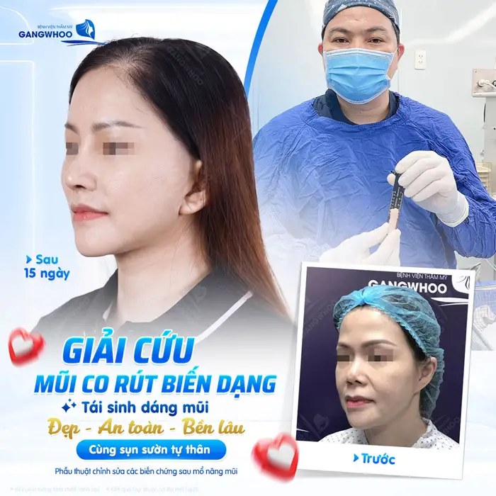 Giải cứu mũi co rút biến dạng tái sinh dáng mũi mới cùng sụn sườn tự thân 
