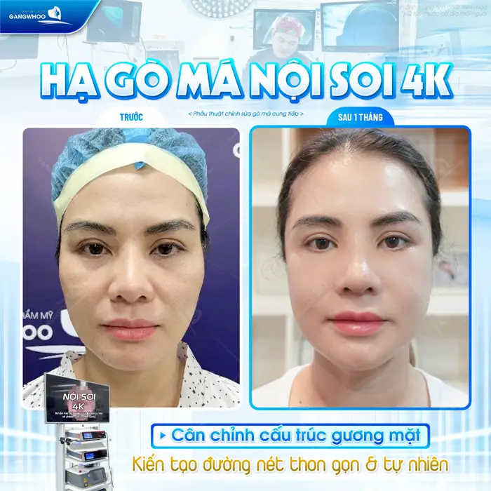 Hạ gò má nội soi 4K cân chỉnh cấu trúc gương mặt kiến tạo đường nét thon gọn và tự nhiên cho diện mạo