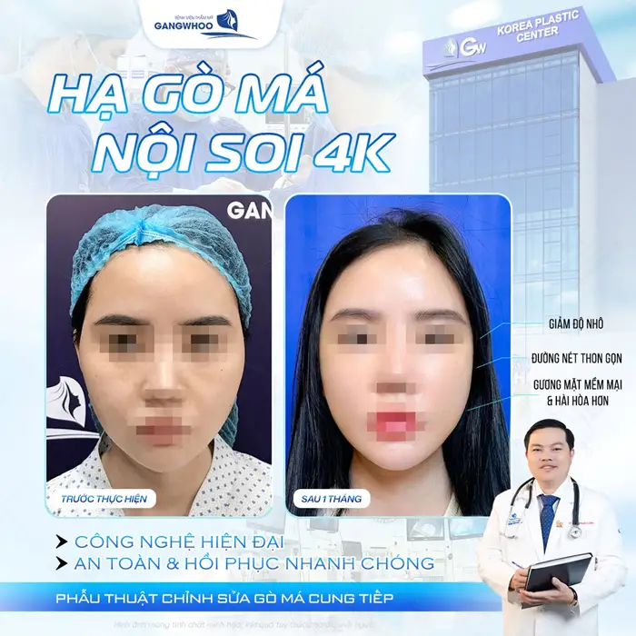 Hạ gò má nội soi 4K công nghệ hiện đại an toàn với thời gian hồi phục nhanh chóng