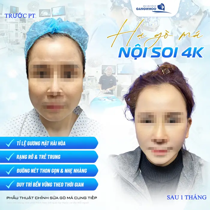 Hạ gò má nội soi 4K mặt đẹp chuẩn tỷ lệ đường nét hài hòa và thon gọn sau phẫu thuật 