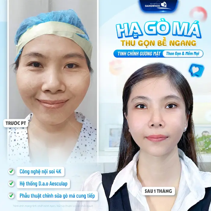Hạ gò má thu gọn bề ngang tịnh chỉnh gươn gmặt thon gọn và mềm mại hơn 
