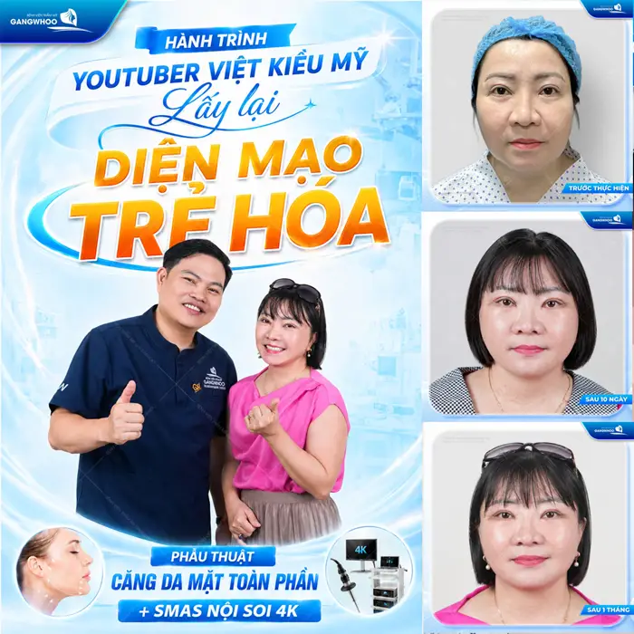 Lấy lại diện mạo trẻ hóa sau phẫu thuật căng da mặt toàn phần Smas nội soi 4K nhan sắc trẻ đẹp đến bất ngờ