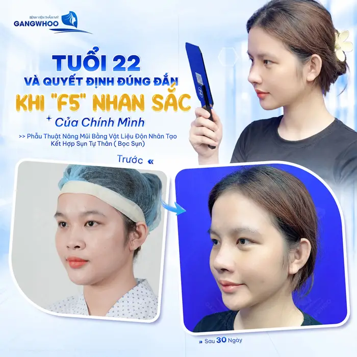 Màn F5 nhan sắc đầy ngoạn mục ở tuổi 22 giúp cô gái trẻ thăng hạng diện mạo thành công