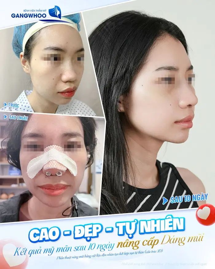 Kết quả mỹ mãn sau 10 ngày nâng cấp dáng mũi cao - đẹp và tự nhiên 