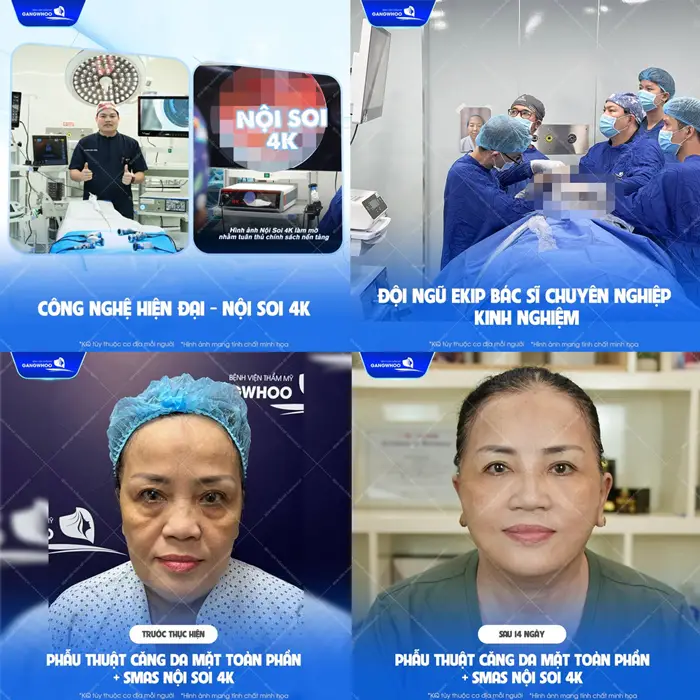 Phẫu thuật căng da mặt toàn phần Smas nội soi 4K kết quả cải thiện hiệu quả và an toàn