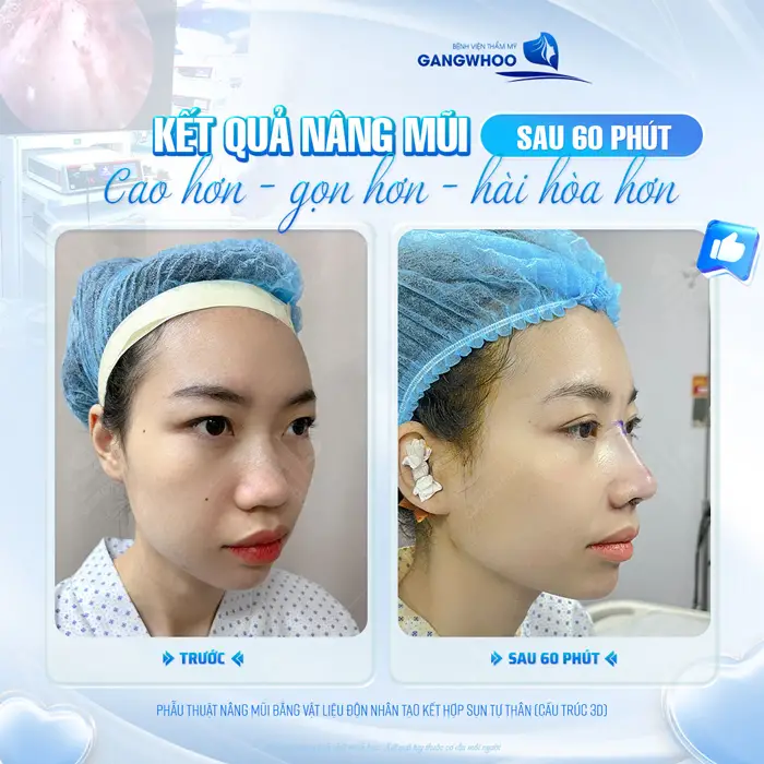 Kết quả nâng mũi sau 60 phút thực hiện mũi cao hơn, gọn hơn và hài hòa hơn 