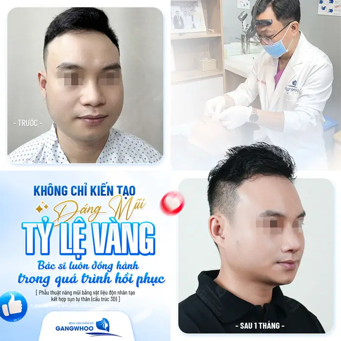 Kiến tạo dáng mũi đẹp chuẩn tỷ lệ vàng bác sĩ luôn đồng hành trong quá trình hồi phục