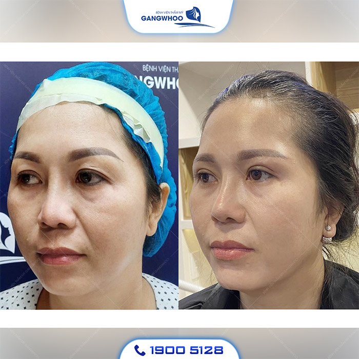 Biến Chứng Nâng Mũi Sụn Sườn Và Phương Pháp Khắc Phục 13 mui hong 1