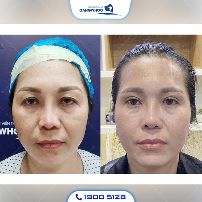 Biến Chứng Nâng Mũi Sụn Sườn Và Phương Pháp Khắc Phục 15 mui hong 3