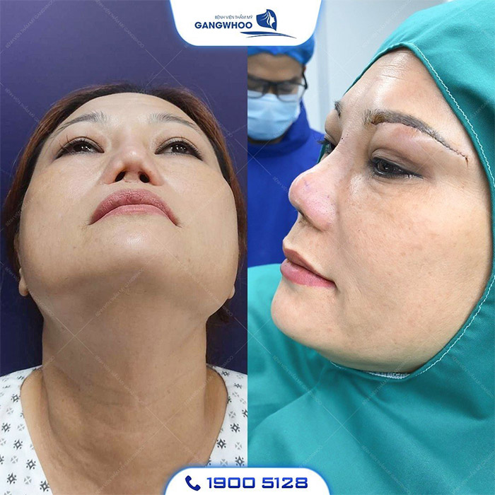 Biến Chứng Nâng Mũi Sụn Sườn Và Phương Pháp Khắc Phục 6 mui hong 6