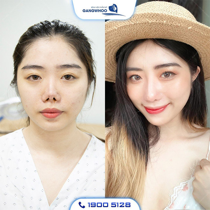 Biến Chứng Nâng Mũi Sụn Sườn Và Phương Pháp Khắc Phục 7 mui hong 7