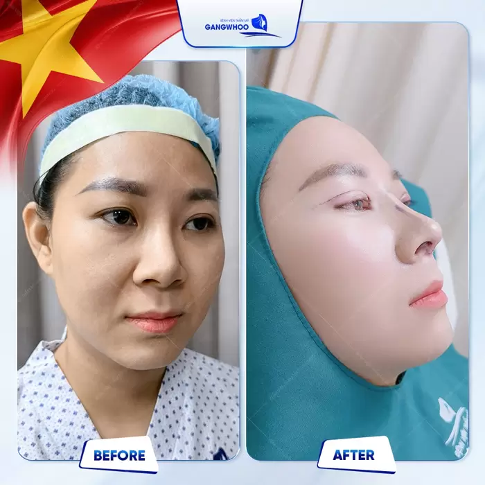 Nâng Mũi Sụn Sườn Có Bị Teo Lại Không? Dr.Robert Giải Đáp