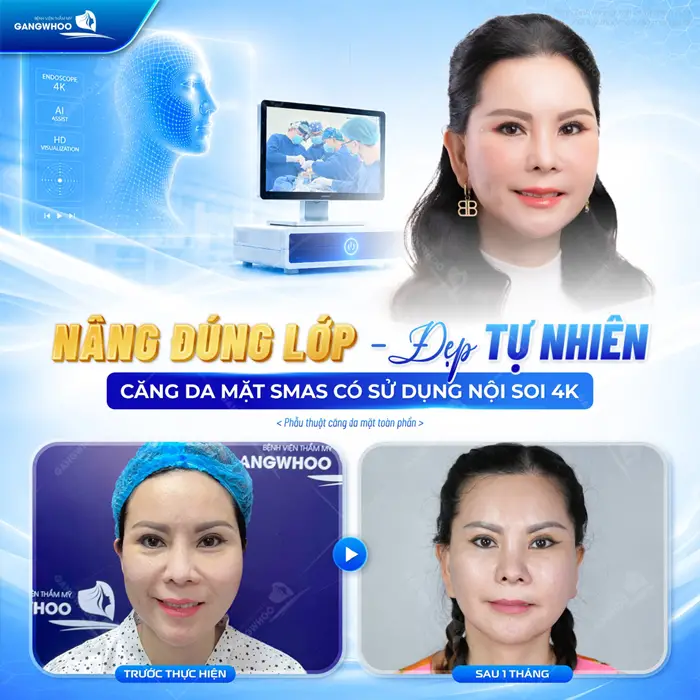 Nâng đúng lớp, đẹp tự nhiên cải thiện diện mạo hoàn hảo sau căng da mặt Smas có sử dụng nội soi 4K