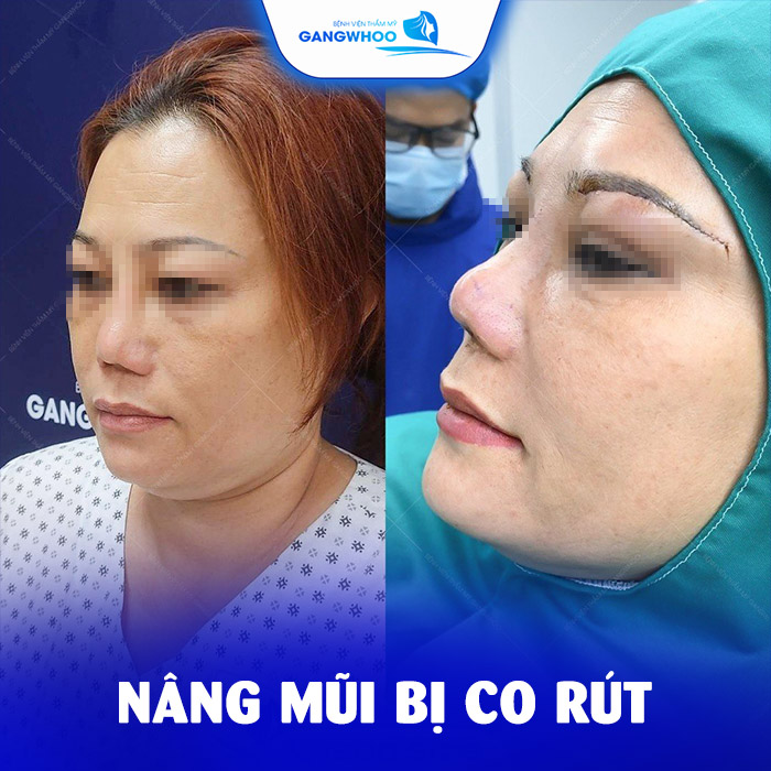 nang mui bi co rut