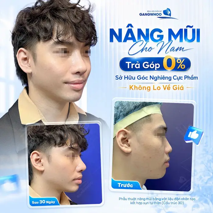 6 Cách Chăm Sóc Sau Nâng Mũi Bọc Sụn Chuẩn Y Khoa 2 Nâng mũi cho nam giới trả góp nhẹ nhàng 0% lãi suất yên tâm không cần phải lo về giá