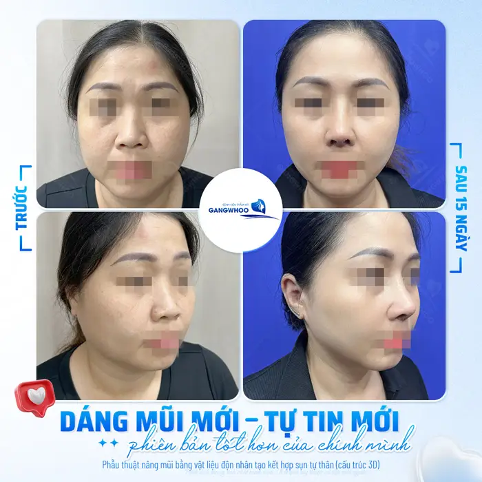 Dáng mũi mới tự tin mới hóa phiên bản tốt hơn của chính mình