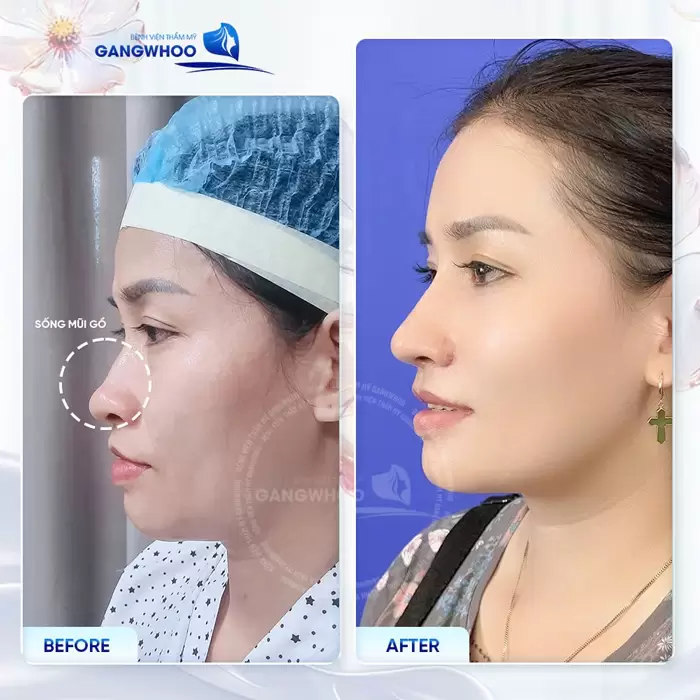 Nâng Mũi Sụn Sườn Có Bị Teo Lại Không? Dr.Robert Giải Đáp