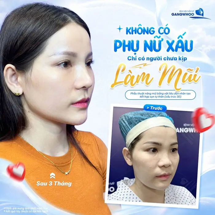 Nâng Mũi Bọc Sụn Megaderm - Giúp Tạo Dáng Mũi Lâu Bền 9 Nâng mũi đẹp bừng nhan sắc diện mạo thêm thăng hạng và đầy rạng rỡ