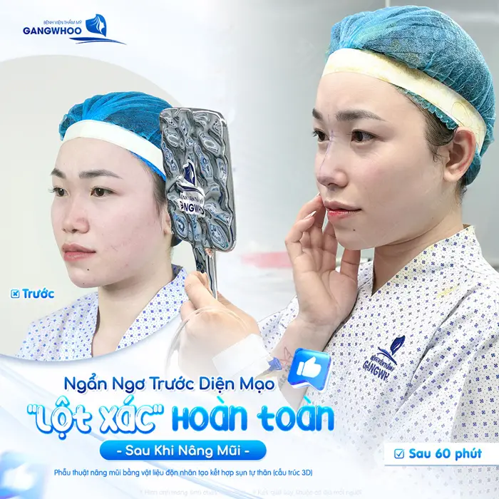 Ngẩn ngơ trước diện mạo "lột xác" hoàn toàn sau nâng mũi nhan sắc có điểm nhấn hơn thấy rõ