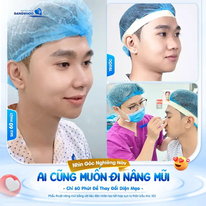 Nâng Mũi Bọc Sụn Megaderm - Giúp Tạo Dáng Mũi Lâu Bền 4 Góc nghiêng đẹp chuẩn thần thái, diện mạo thêm bừng sắc sau phẫu thuật đường nét gương mặt đã thêm ấn tượng