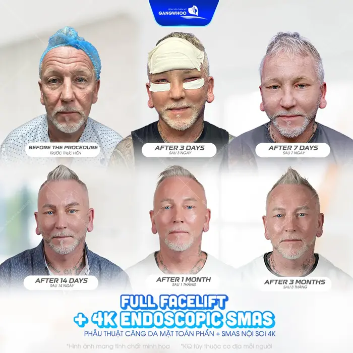 Phẫu thuật căng da mặt toàn phần Smas nội soi 4K kết quả thay đổi rõ rệt theo từng ngày