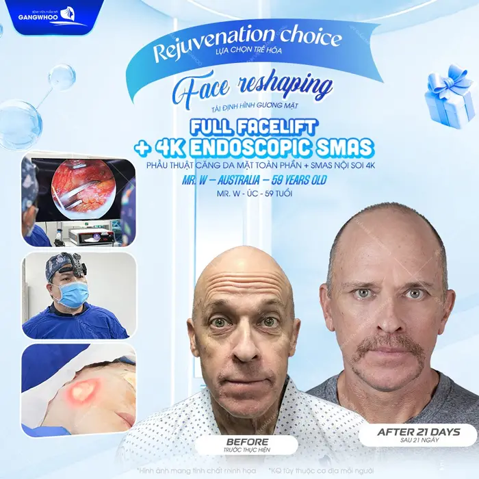 Phẫu thuật căng da mặt toàn phần tái định hình đường nét gương mặt thêm phẳng mịn, như ý