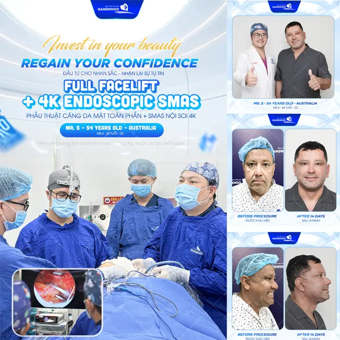 Phẫu thuật căng da mặt toàn phần sự đầu đắn cho nhan sắc lâu dài 