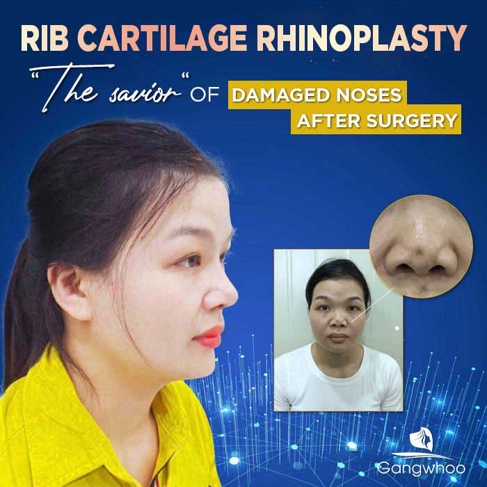 pros and cons of rib cartilage rhinoplasty 3