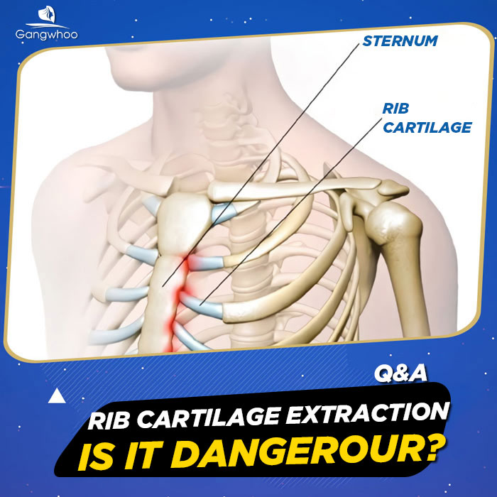pros and cons of rib cartilage rhinoplasty 4