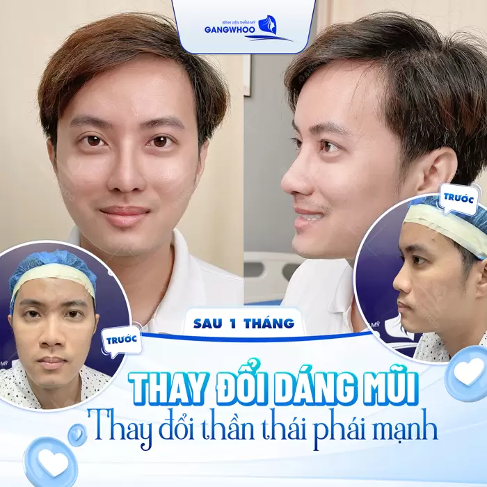 Sau 1 tháng thay đổi dáng mũi thay đổi thần thái chuẩn phái mạnh