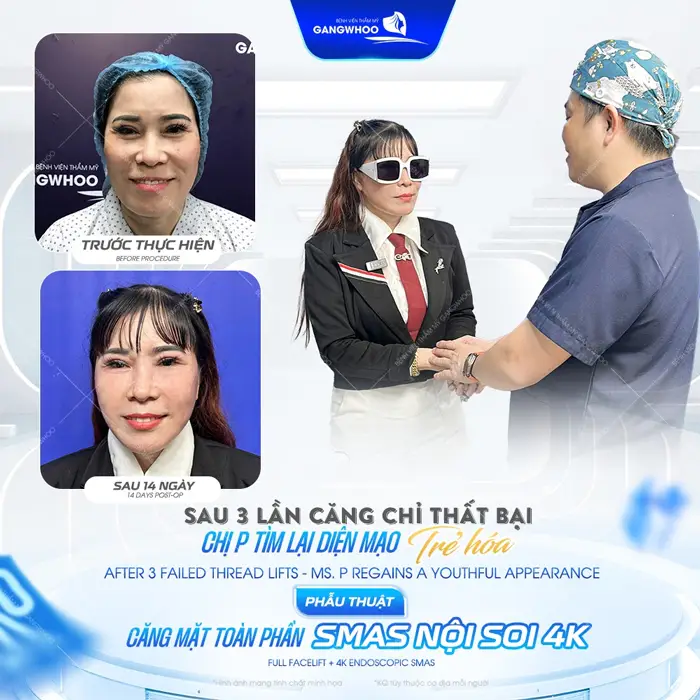 Sau 3 lần căng chỉ thất bại đến Gangwhoo lần thứ 4 làm phẫu thuật căng da mặt toàn phần mới thành công