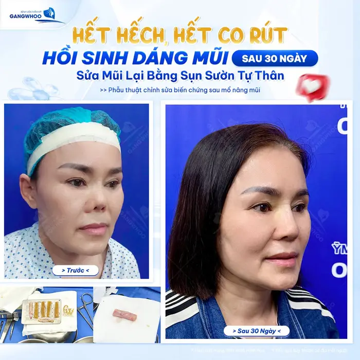 Hồi sinh dáng mũi sau 30 ngày sửa mũi lại bằng sụn sườn tự thân khắc phục biến chứng mũi hếch và co rút