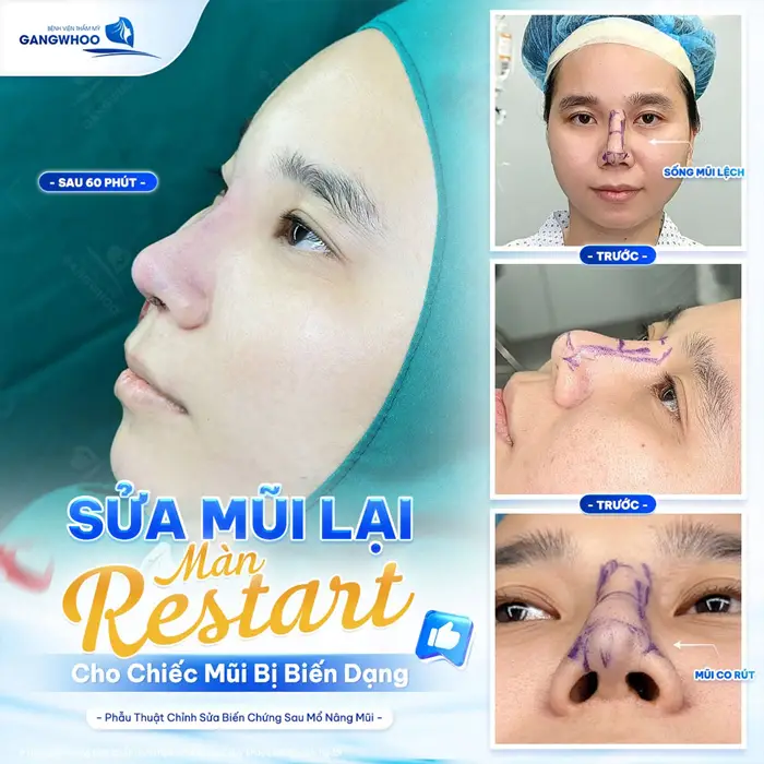Biến Chứng Nâng Mũi Sụn Sườn Và Phương Pháp Khắc Phục 4 Sửa mũi lại màn "Restart" nhan sắc hiệu quả cho sống mũi bị biến dạng và thiếu cân đối