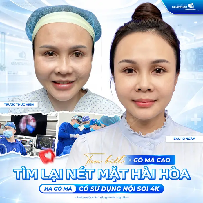 Tạm biệt gò má cao tìm lại đường nét hài hòa sau 10 ngày hạ gò má có sử dụng nội soi 4K