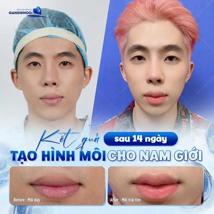 Tạo Hình Môi Trái Tim Cho Đôi Môi Quyến Rũ Mọi Chàng Trai 20 Ngoài phụ nữ, nam giới cũng lựa chọn tạo hình môi trái tim tại Gángwhoo