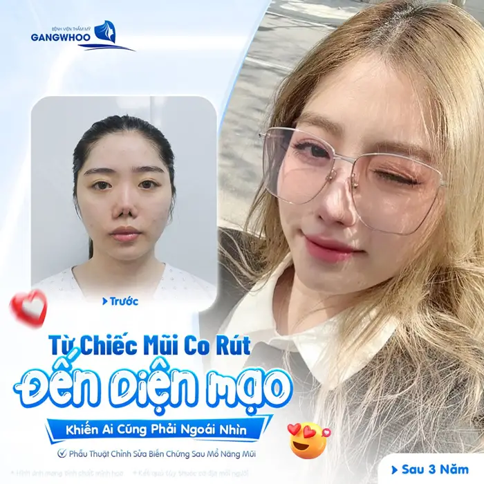 Biến Chứng Nâng Mũi Sụn Sườn Và Phương Pháp Khắc Phục 1 Từ chiếc mũi co rút đến diện mạo khiến ai cũng phải ngoái nhìn vì quá xinh đẹp và hài hòa