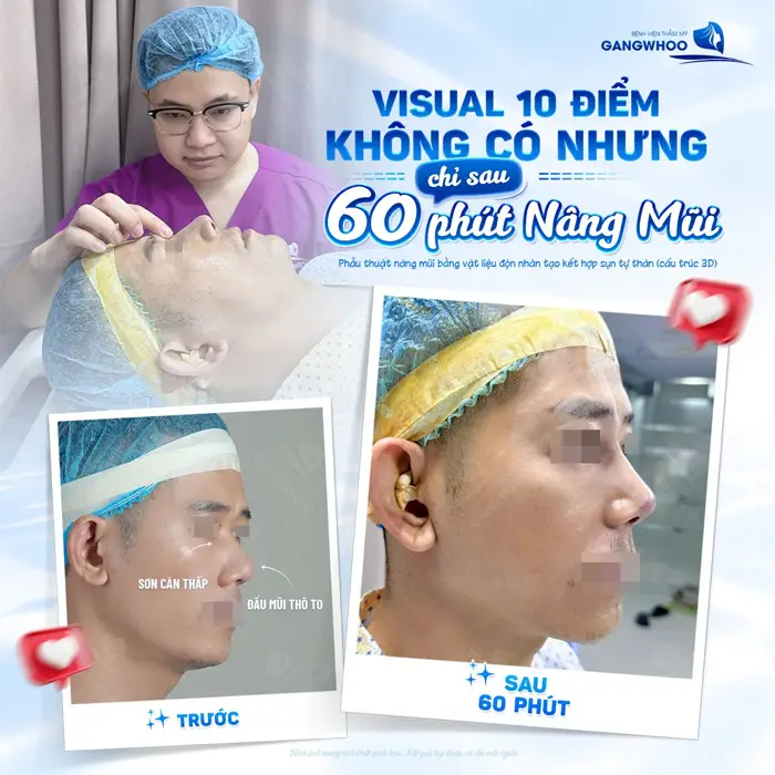 Visual 10 điểm chỉ sau 60 phút nâng mũi đã đẹp và tự tin khoe góc nghiêng đẹp chuẩn cuốn hút