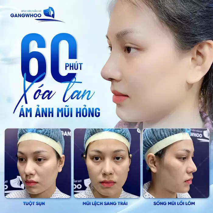 Nâng Mũi Sụn Sườn Có Đau Không