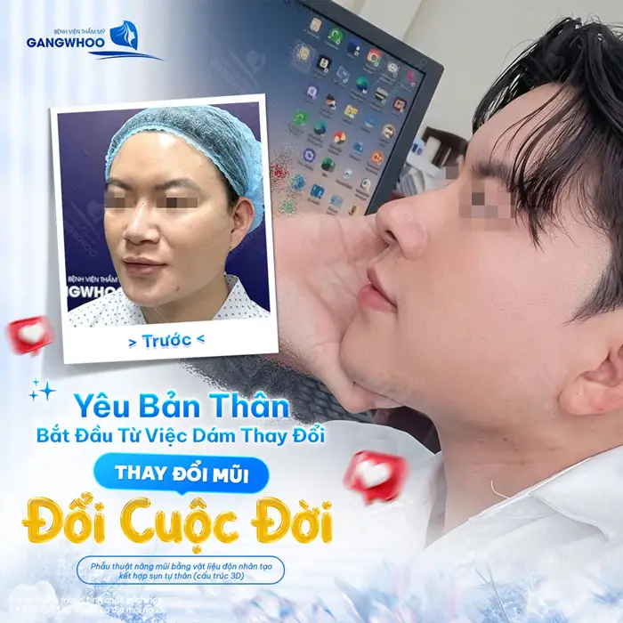 Nâng Mũi Bọc Sụn Có An Toàn Không? 4 Tiêu Chí Quyết Định 3 Thay đổi dáng mũi thay đổi cuộc đời sau phẫu thuật nâng mũi tại Gangwoo góc nghiêng đẹp chuẩn soái ca