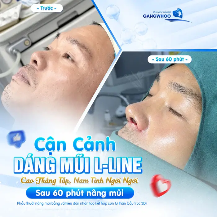 Cận cảnh dáng mũi L Line cao thẳng tắp, nam tính ngời ngời sau 60 phút nâng mũi