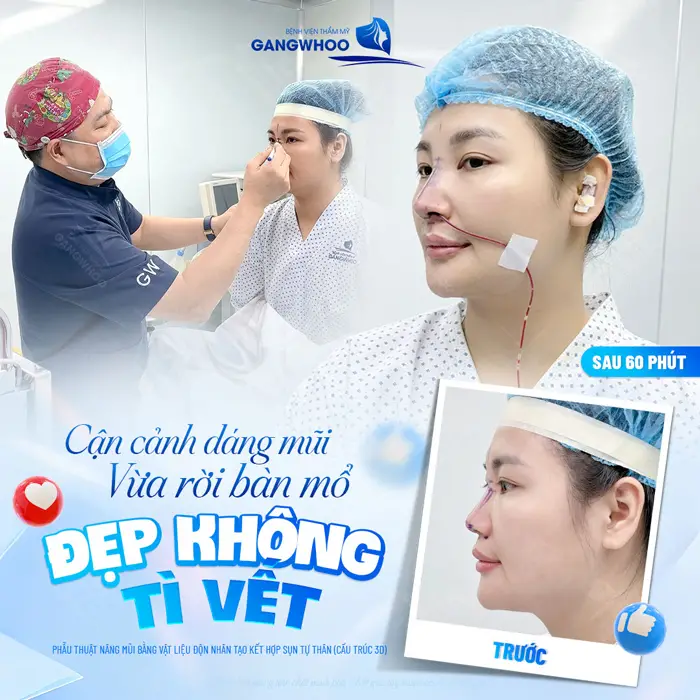 Cận cảnh dáng mũi vừa rời bàn mổ đẹp không tì vết 